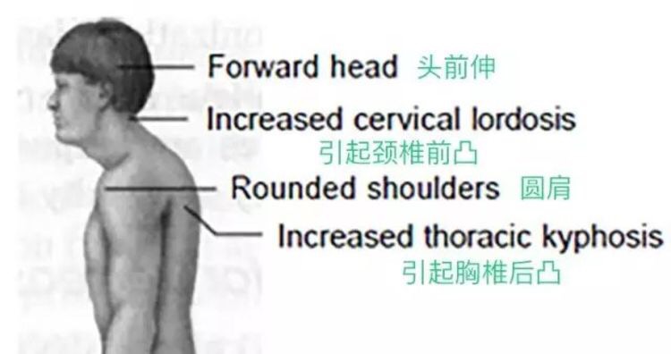 驼背改善