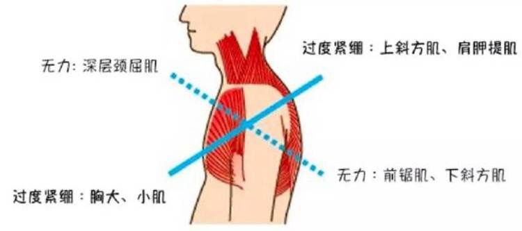 驼背改善